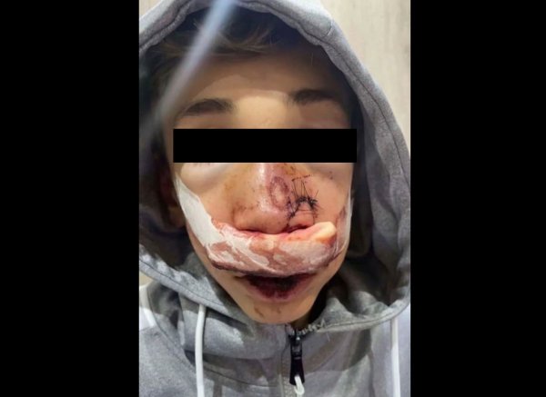 Violences policières : la police défigure un jeune de 13 ans d'un tir de LBD au visage à Argenteuil